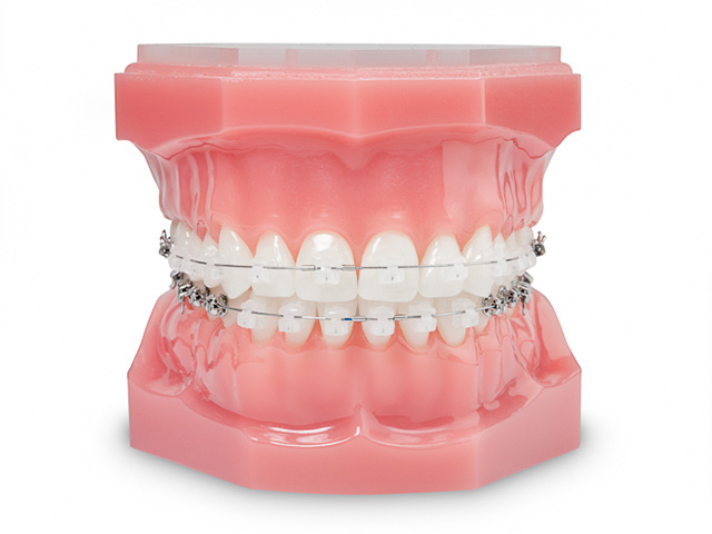 Festsitzende Zahnspange  Fachpraxis für Kieferorthopädie